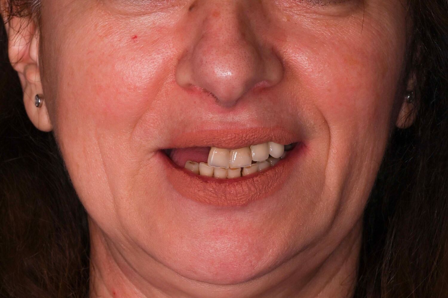 Pacient Clinica Dr. Alin Odor - Rezultat Implantologie